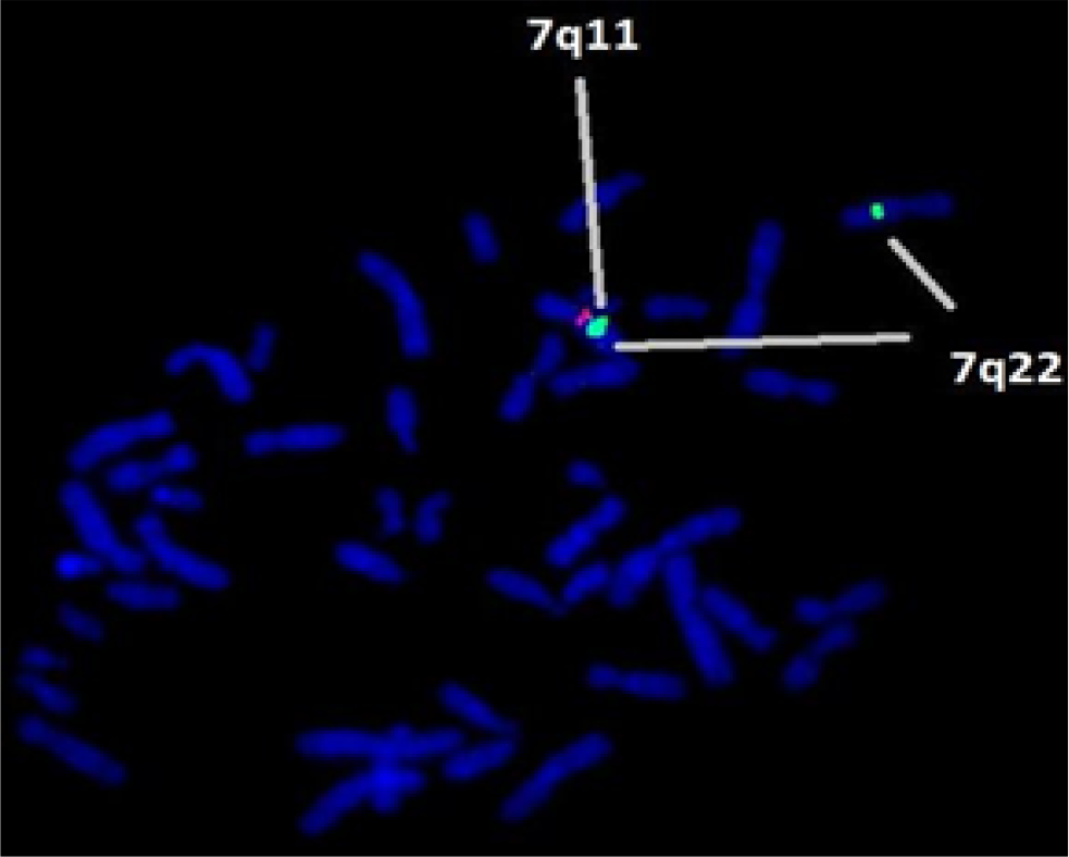 FISH technique shows microdeletion of 7q11.23 containing the Elastin (ELN) gene locus in all metaphases.