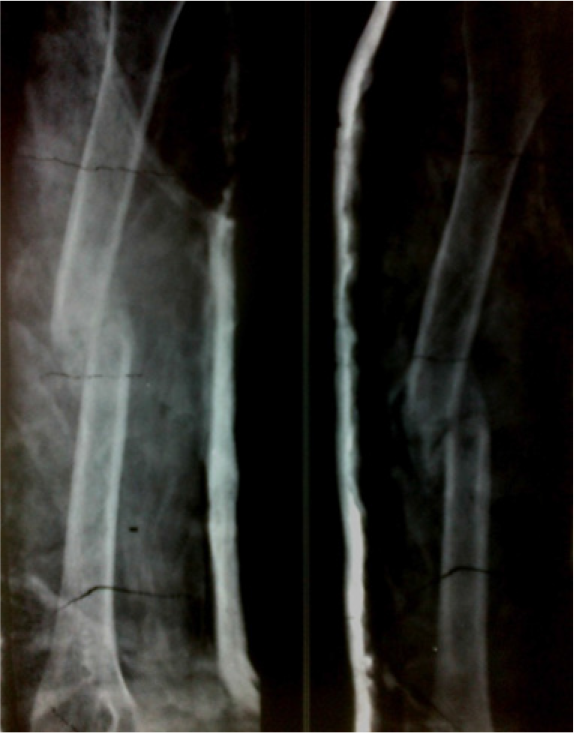The radiograph following application of functional plaster splint and showing uniting fracture.