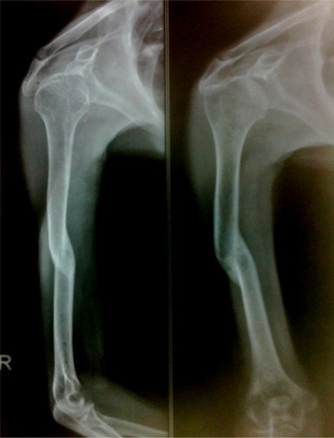 The follow up radiograph showing united fracture.