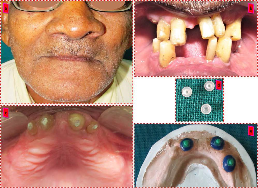 (a) Extra oral view of the patient showing increased lower third of the face (b) Intraoral view showing remaining natural teeth (c) Remaining teeth after endodontic treatment (d) O ring (e) Wax pattern engulfing a premachined plastic precision attachment.