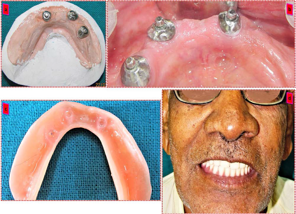 (a) Cast dowel attachment (b) Cast attachment cemented to remaining roots (c) O ring attached to complete denture (d) Final completed denture.