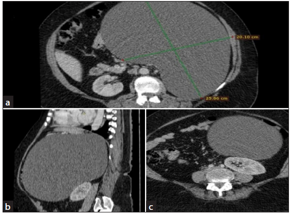 CT-Scan Abdomen with IV-Contrast. Panel (a): Axial view of CT-Abdomen IV contrast showing huge left-sided cyst 25*20 cm with no solid component and septations with few areas of calcifications. Panel (b): Sagittal View of CT-Abdomen IV contrast showing huge cyst arising from left adrenal gland displacing pancreas superiorly and kidneys inferiorly. Panel (c): Axial view of CT-Abdomen showing cyst compressing the left kidney.