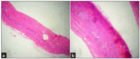 Histopathology: (a) Histological examination of sections reveals adrenal gland parenchyma showing a cystic cavity containing hemorrhagic material and hemosiderin-laden macrophages in the lumen. (b) No definitive cyst lining epithelium is identified in the section examined. No evidence of any granulomatous process of malignancy is seen.
