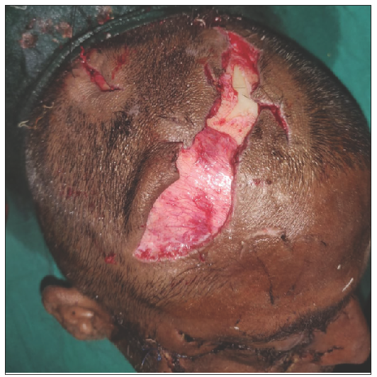 Image showing laceration measuring 4 x 3 cms on frontal and right temporal scalp area.