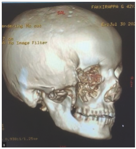 CT image showing a missing right zygoma and right floor of the orbit including the zygomatic arch.