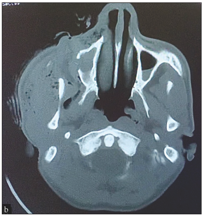 CT image showing no damage to the underlying dura or cerebral structures.