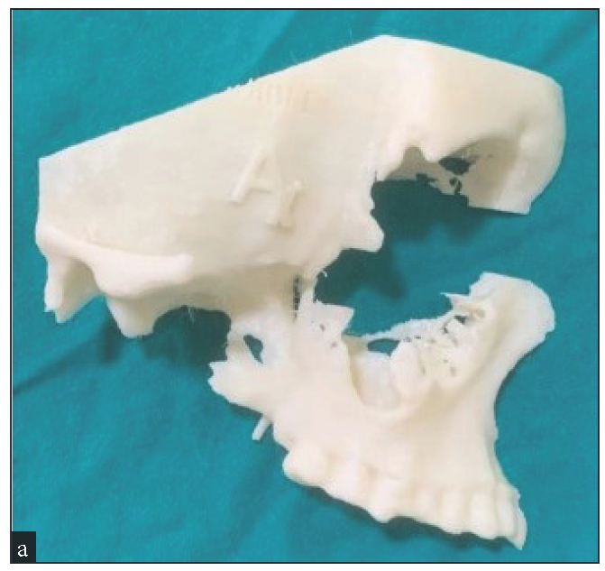 Image showing 3D computer mode of right zygoma.