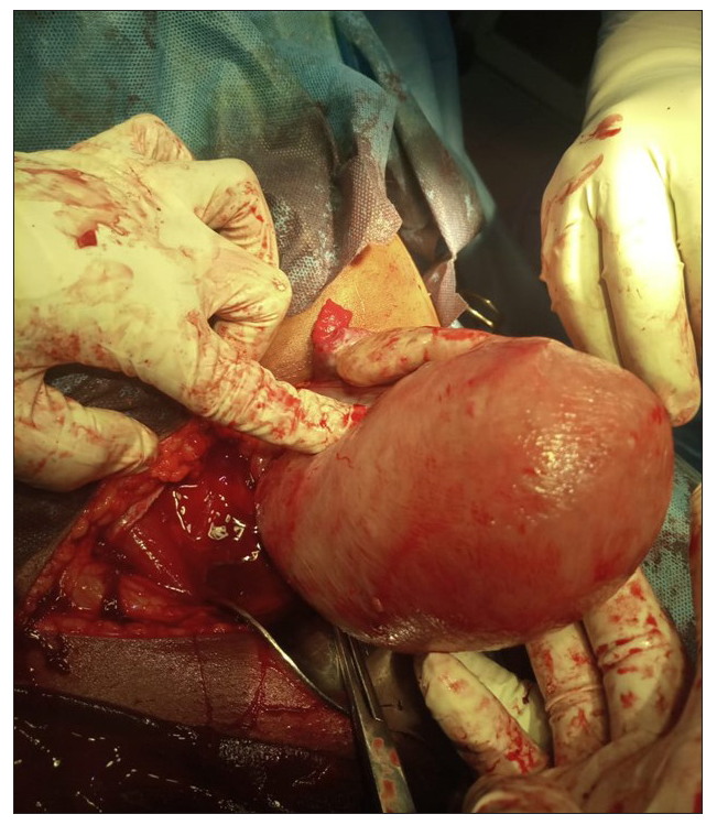 Shows the absence of the left ovary, fallopian tube, and broad ligament.