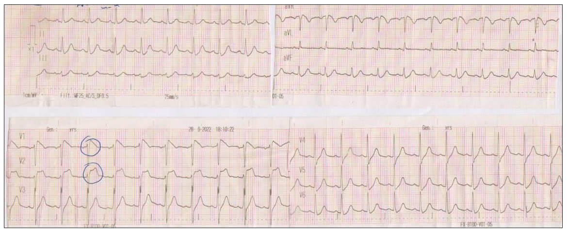 The initial ECG of the patient in the Emergency Department with a fever of 39°C. ECG: Electrocardiogram