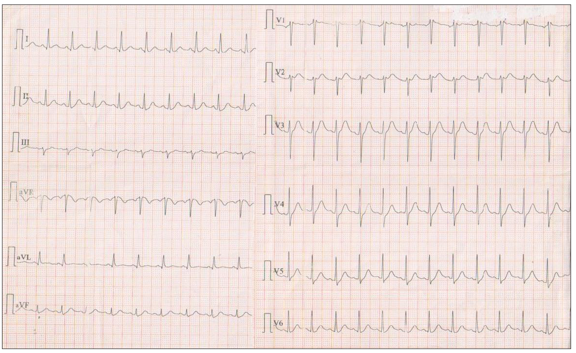 The ECG of the patient after the resolution of the fever. ECG: Electrocardiogram