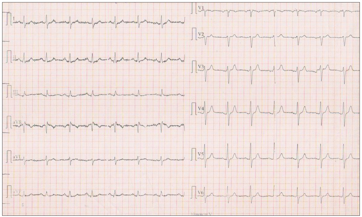 Baseline ECG at the initial visit. ECG: Electrocardiogram