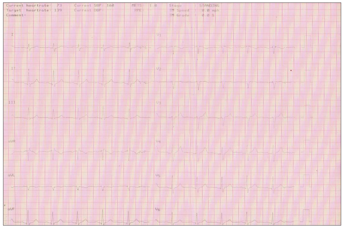 Stress test. Initial ECG with a saddle-like ST segment elevation in V1-V2 leads consistent with Brugada syndrome type 2 pattern. ECG: Electrocardiogram