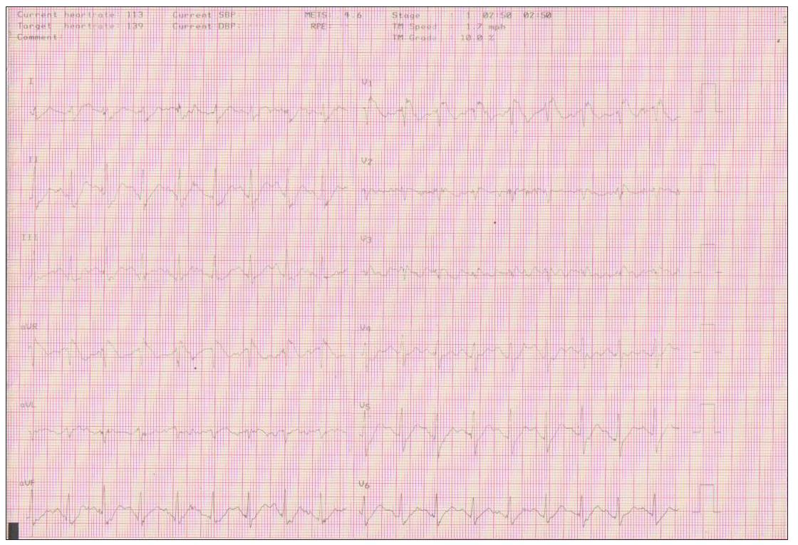 Stage 1 of the Bruce protocol where the ECG Brugada pattern appears at 2΄ 50΄΄ duration of exercise and heart rate at 136 beats/min. ECG: Electrocardiogram