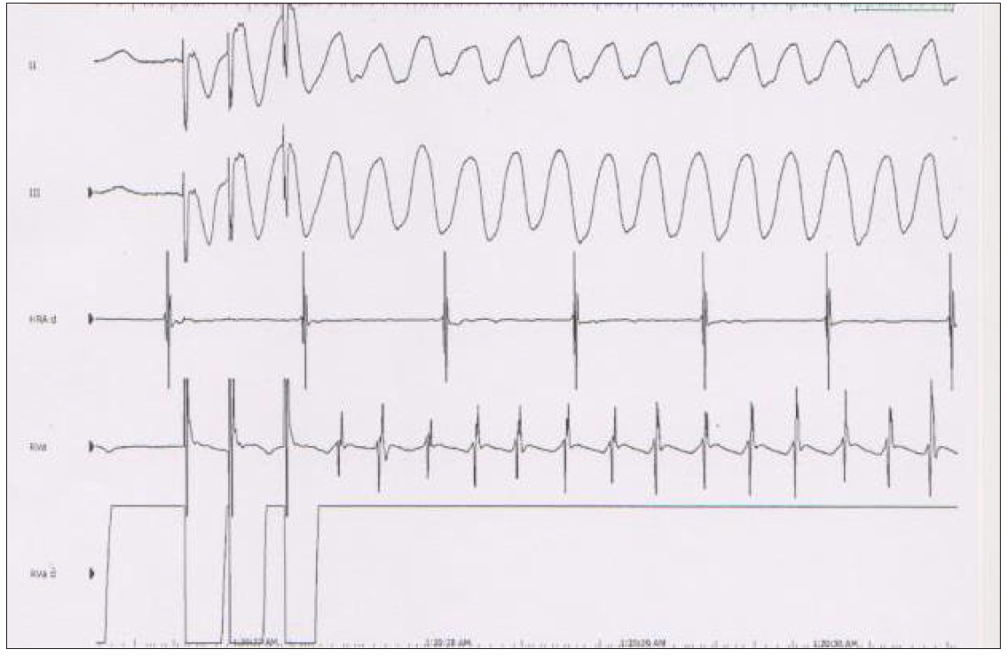 Nonsustained ventricular tachycardia (VT) was induced during programmed electrical stimulation protocol at 500 msec cycle length and two extrastimulus 200/340 msec after isoproterenol administration.