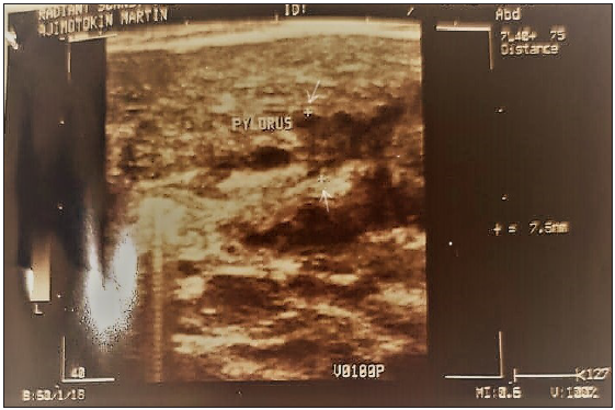 B-mode sonogram of the patient showing hypertrophied heterogeneously hypoechoic pylorus (upper +/arrow: upper margin of hypertrophied gastric pylorus; lower +/arrow: lower margin of hypertrophied gastric pylorus).