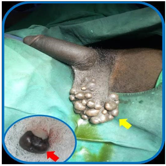 Physical examination findings. Scrotal calcinosis cutis as shown by multiple scrotal nodules, yellow arrow, insert (nodule biopsy specimen, red arrow)