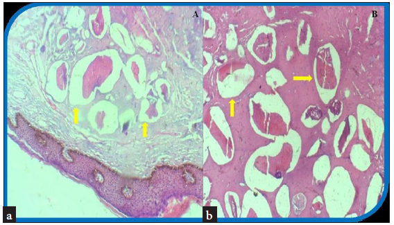 Histologic findings. (a) Photomicrograph showing keratinized pigmented epidermis overlying calcified masses (yellow arrows) in deep dermal scrotal tissue, no cystic wall or lining (10 x 100 magnifications) (b) Photomicrograph showing calcific subcutaneous masses embedded within fibrocollagenous tissues (yellow arrows) (40 x 100 magnifications).